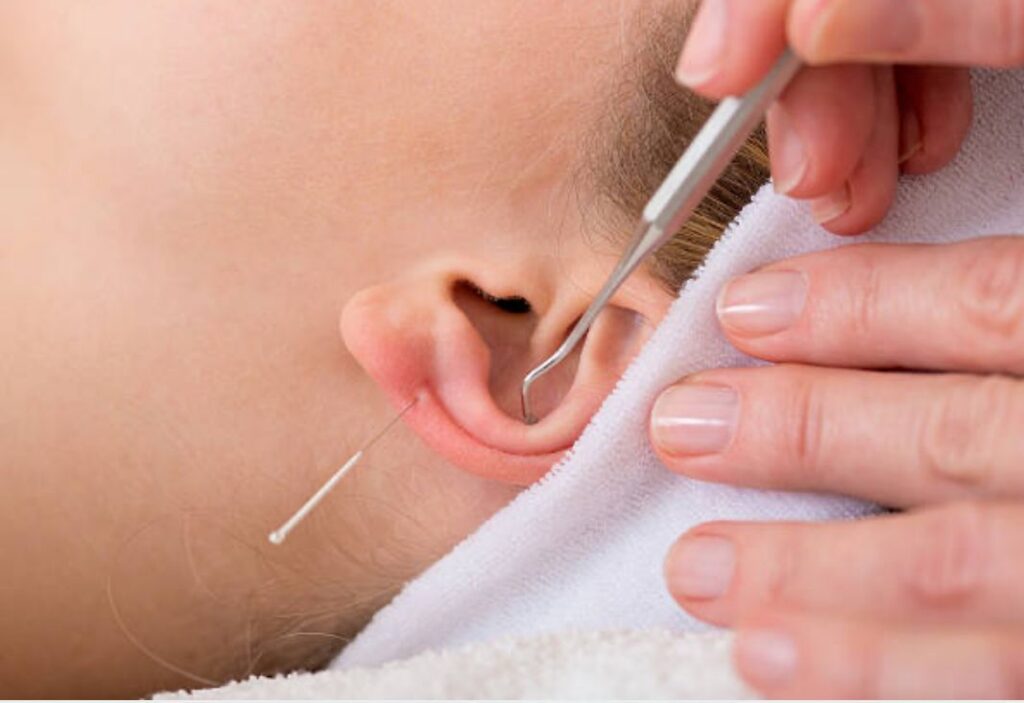 Zoom sur une oreille recevant un soin d’auriculothérapie avec une aiguille et un outil métallique, dans un cadre thérapeutique professionnel à Asnières-sur-Seine