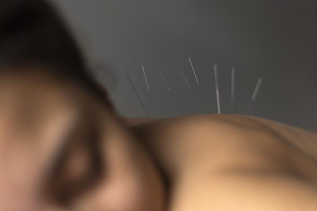 Personne allongée recevant un soin d’acupuncture avec plusieurs aiguilles fines insérées dans le dos.